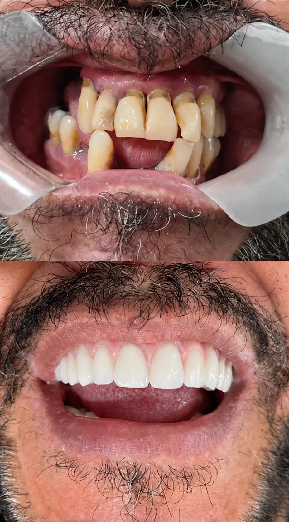 Caso real de Prótese Protocolo Fixa — antes e depois — Clínica Isiortho
