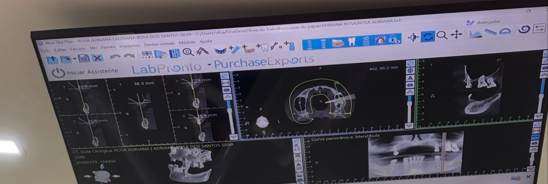 Planejamento digital de Implante Dentário com cirurgia guiada - Clínica Isiortho